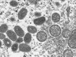 Vietnam detecta primer caso de viruela símica