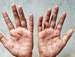 Ministerio de Salud recomienda medidas para prevenir la viruela símica