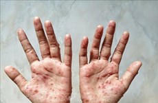Laos detecta el primer caso de viruela símica