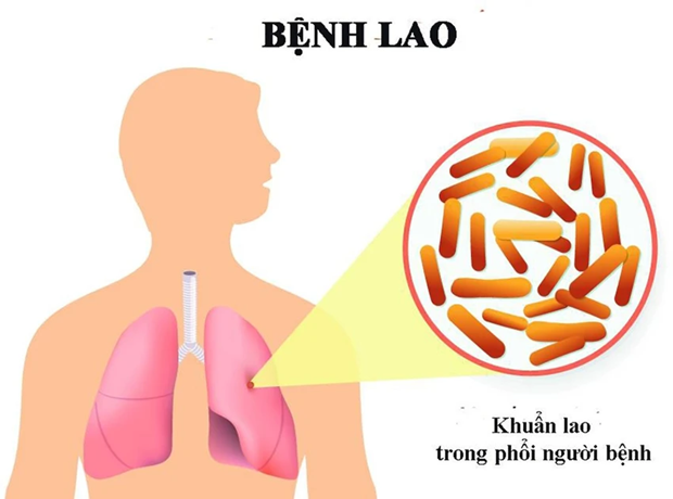 Premier de Vietnam llama a fortalecer lucha contra tuberculosis hinh anh 1